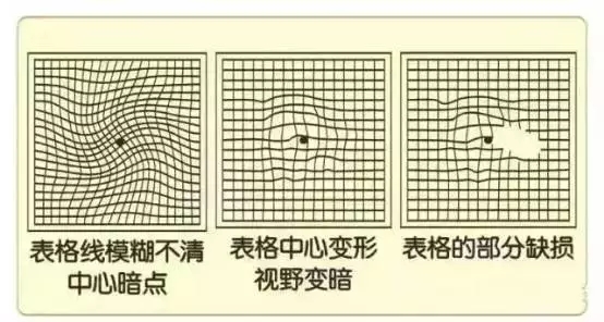 眼底病會引起的6大危害，看圖自測眼底病。