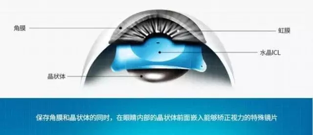 高度近視？ICL可幫您擺脫各種眼鏡 ！